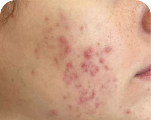 Acne antes